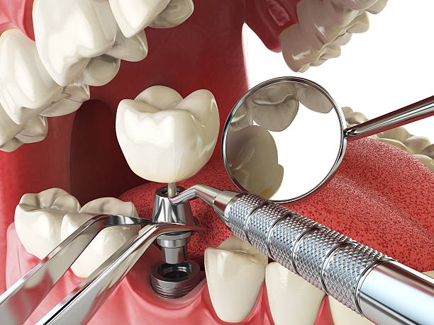 Best Emergency Tooth Extraction in Piedmont, SD